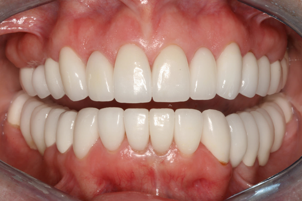 Full mouth rehabilitation