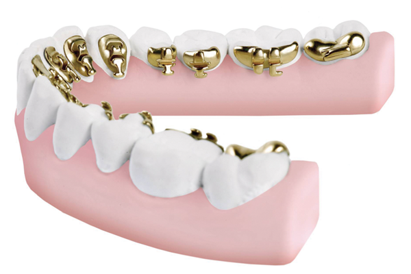 Lingual braces