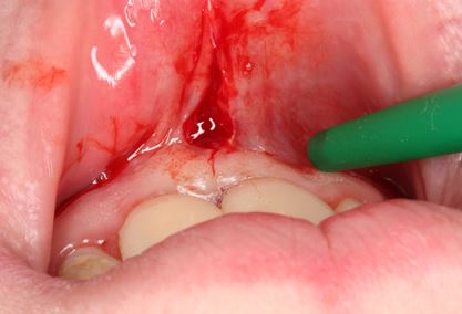 Frenectomy