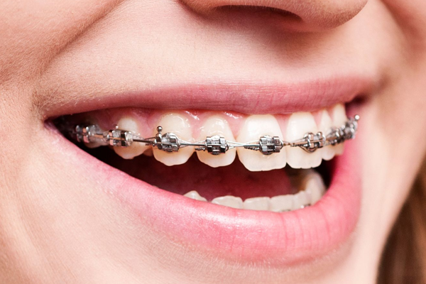dental braces