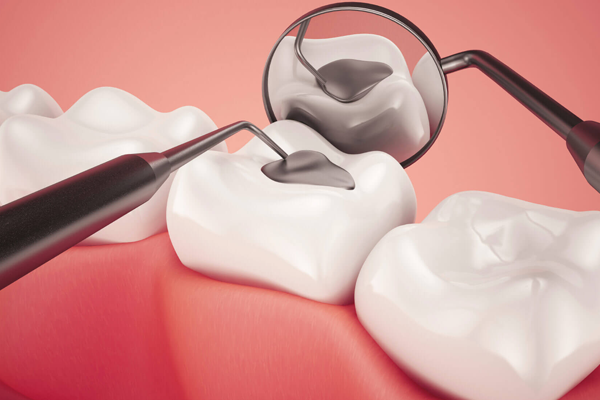 cavity filling