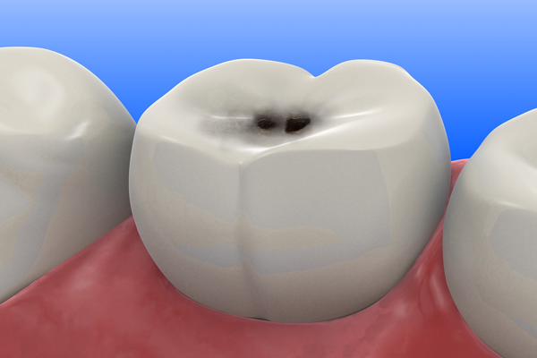 cavity filling