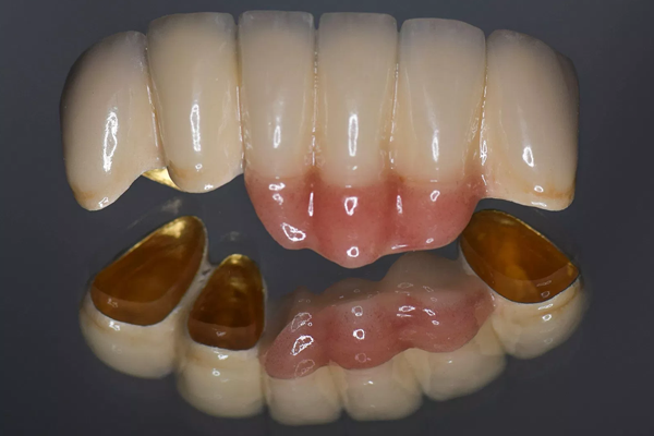 Crowns