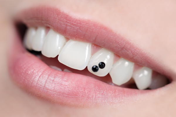dental jewellery