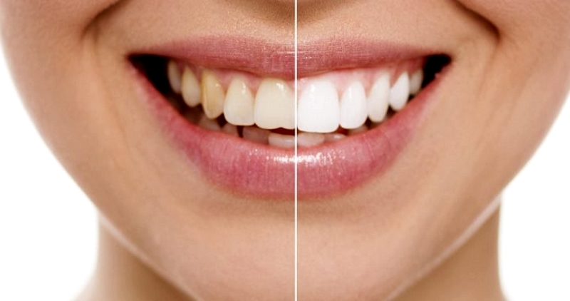enamel shaping