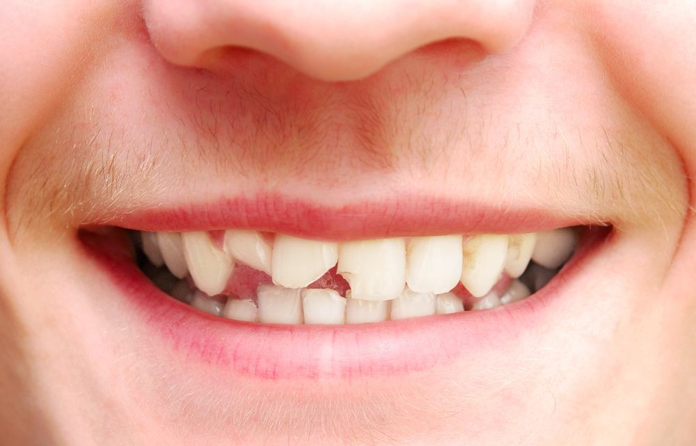 fractured dentist