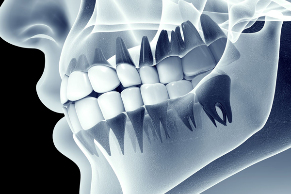 Jaw Deformity Correction Orthognathic