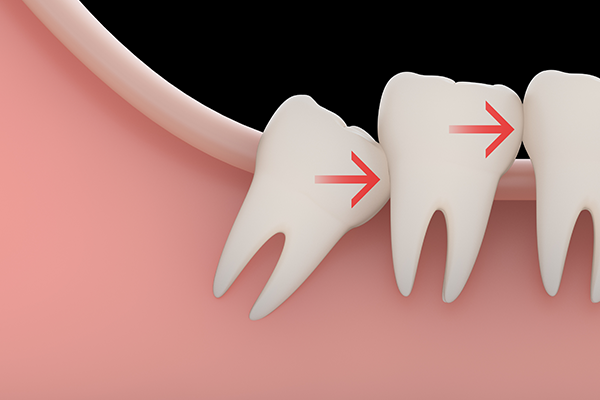 wisidom teeth removal